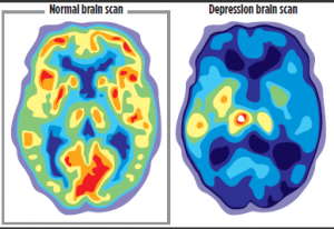 Depression brain