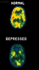 01 Jul 2007 --- Normal and depressed brain PET Scans --- Image by © ScienceVU/DOE,/Visuals Unlimited/Corbis